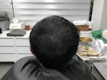 두피문신(직후)