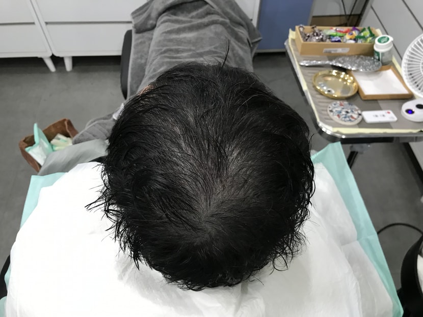 두피문신(전)