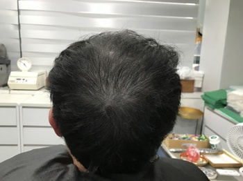 두피문신(전)