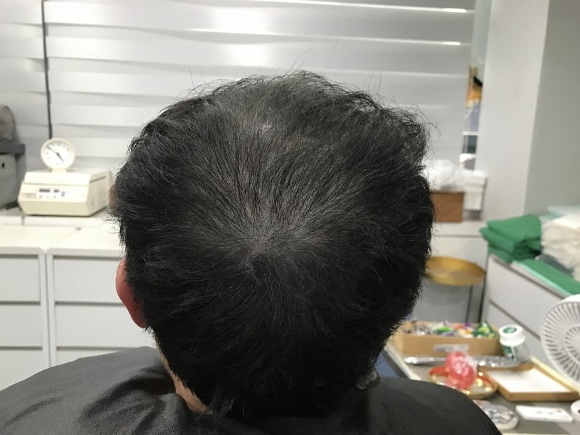 두피문신(전)