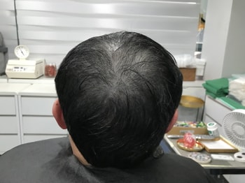 두피문신(전)