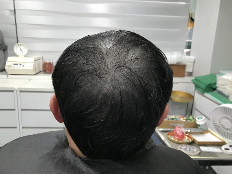 頭皮のタトゥーの体験談をアップします。