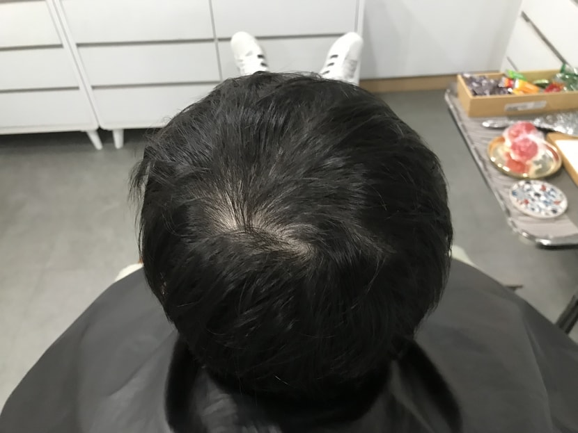 시술 전 마른머리입니다