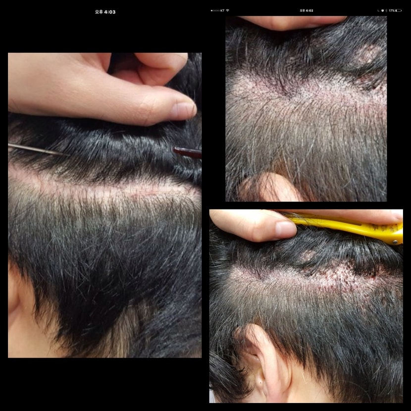 후두부흉터 색소 전 (좌)& 후두부흉터 색소 후(우)