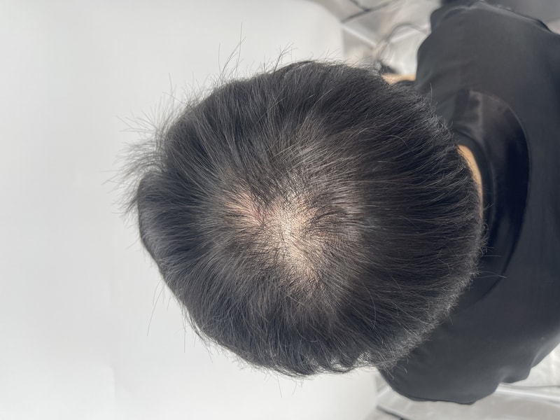 [New Hair] 头皮纹身 2次后期