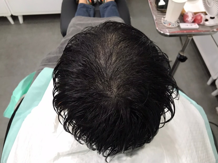 시술과정