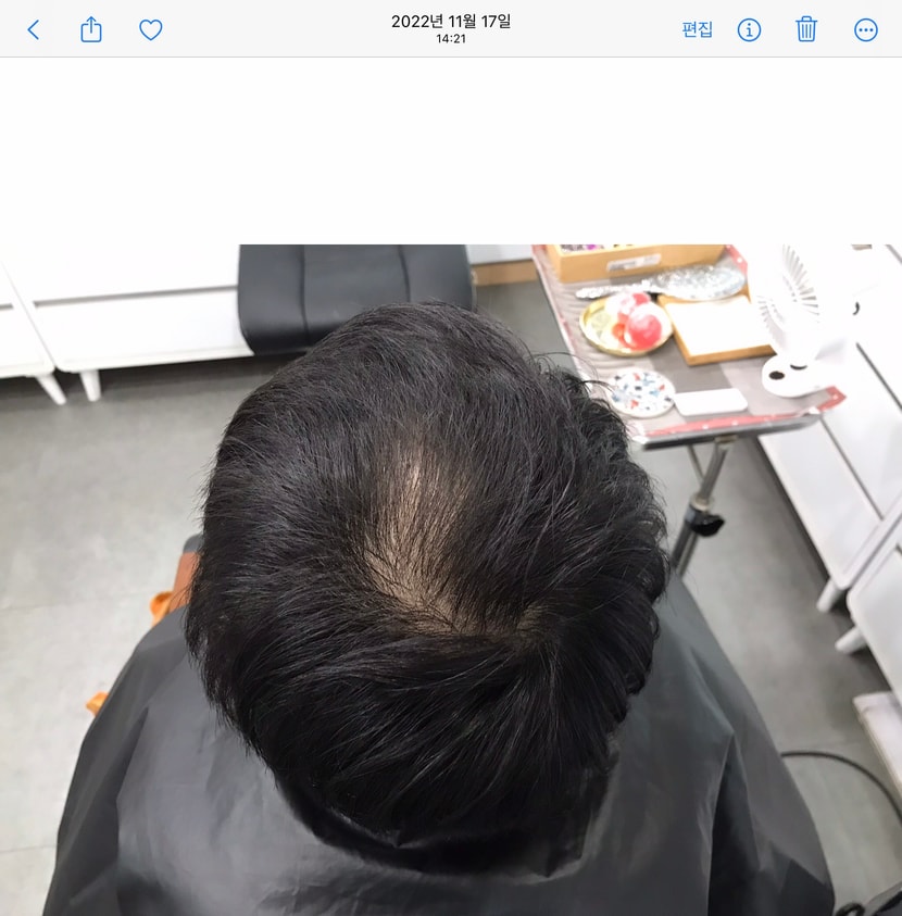 시술전 (22년 11월)