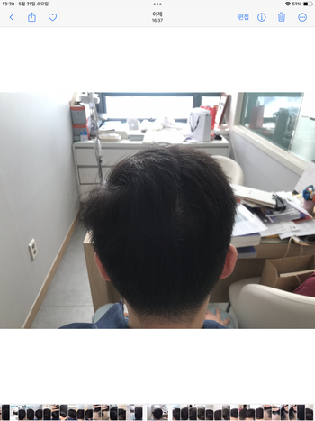 두피문신 7년 후 현재