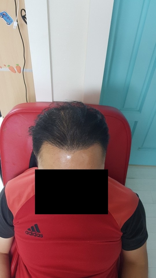 두피문신 4개월 후 변신