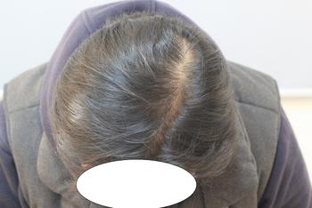 시술전 1