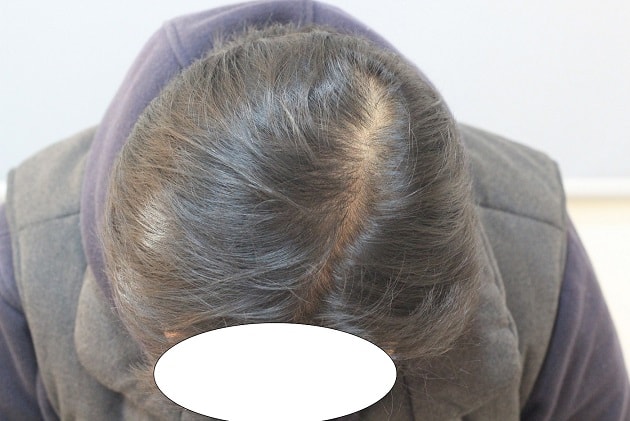 두피문신 7개월차