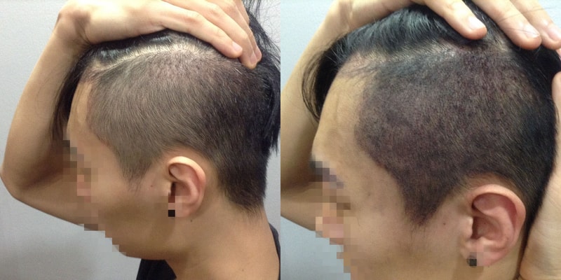 色素疗法头顶，侧发后记~！