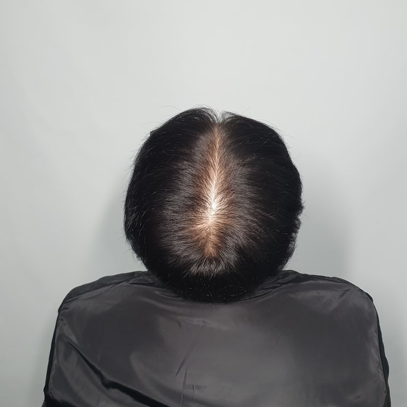 시술전