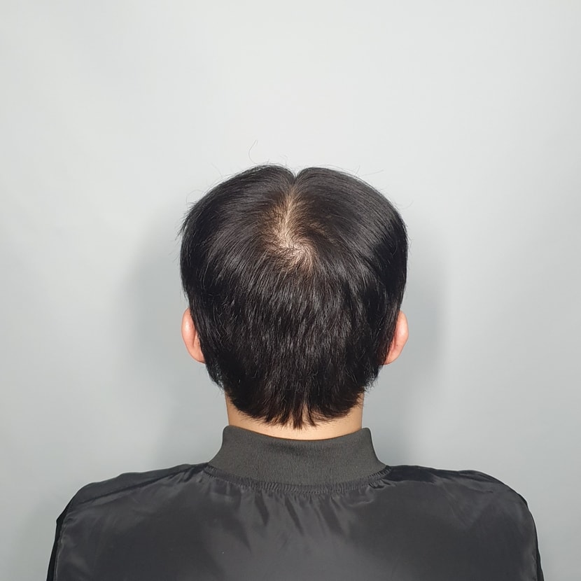 시술전