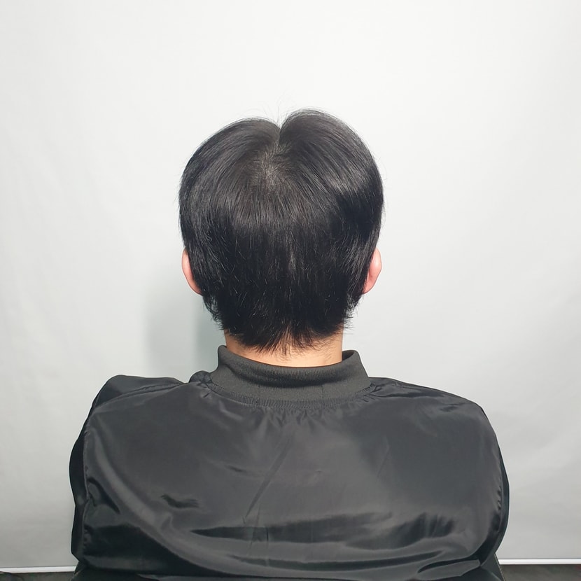 시술후