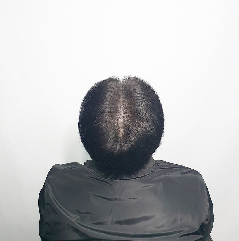 시술후