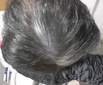 시술 후 6개월 2