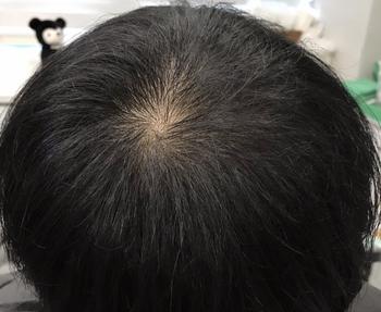 시술 전