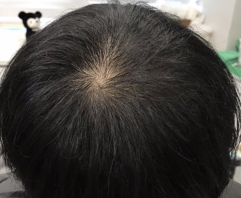[ヨンセミダイン] 頭頂部の頭皮タトゥー5年目の体験談_ 大量に入ってこなくなりますね。