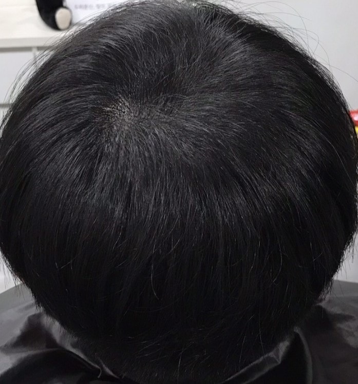 정수리 라인 시술 후