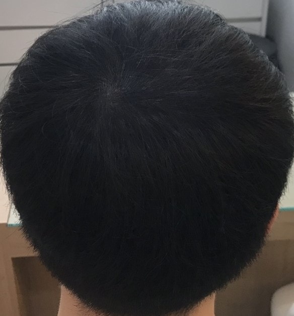 정수리 라인 시술 약 2년 후 (약 같이)
