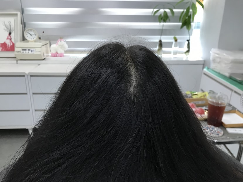 시술전 마른상태