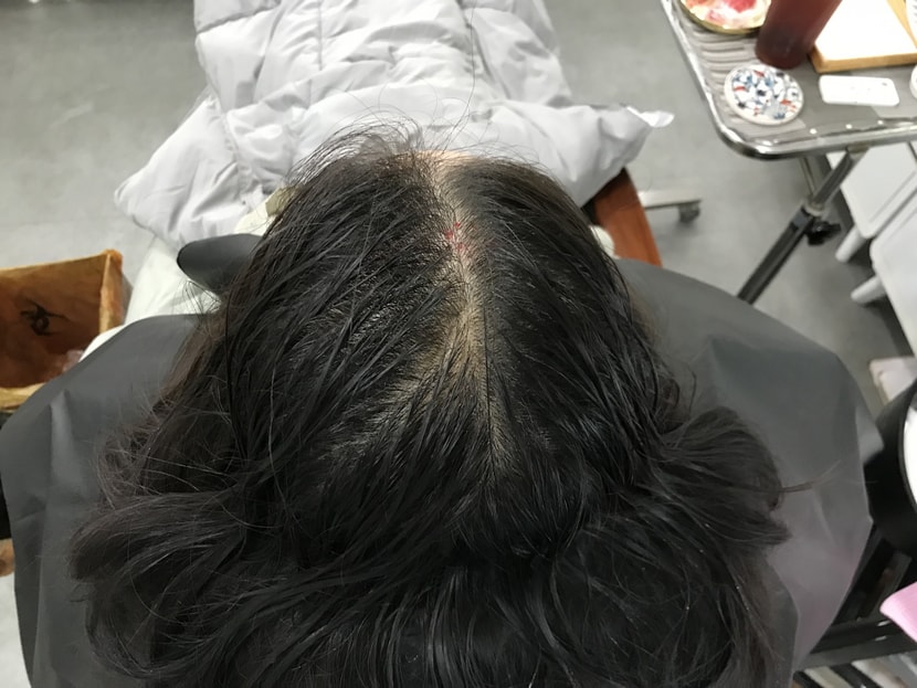 시술전 젖은 상태