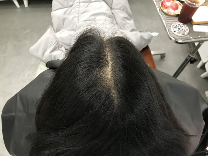 시술전 마른상태