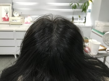 시술후 마른 상태