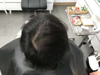 시술 전 (물x)