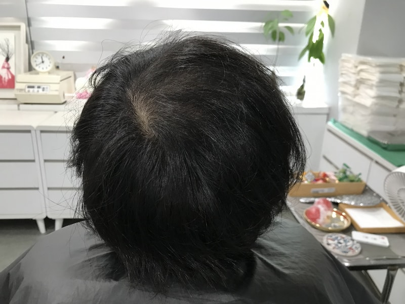 남자 정수리 그라데이션 도트 후기