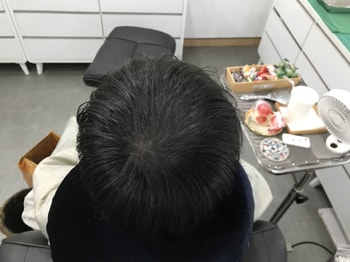 시술 후 (물x)