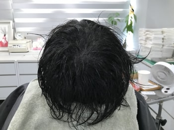 시술 후 (물o)