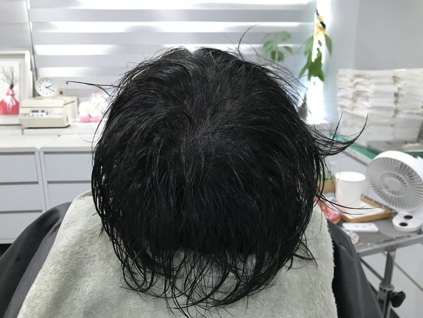 시술 후 (물o)