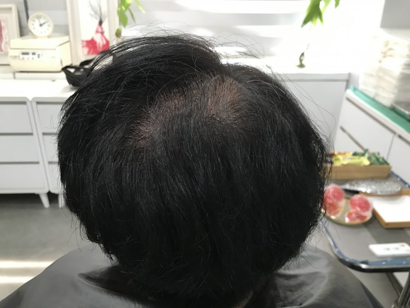 연세미다인 두피문신 후기입니다.