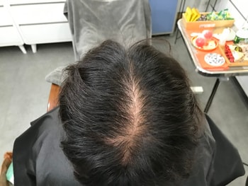 시술 전 마른상태