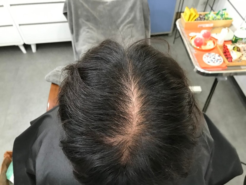 시술 전 마른상태