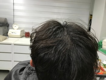 시술 후 뒷정수리
