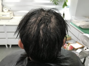 두피문신 전