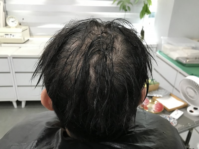 头皮纹身 [延世美多仁] 后记