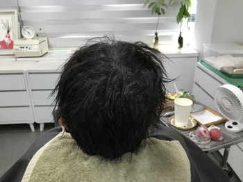 두피문신 후