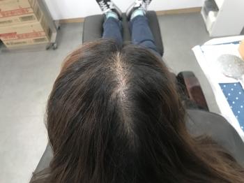시술전