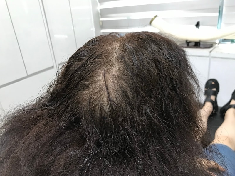 [头皮纹身] 延世大学 头皮纹身 后记