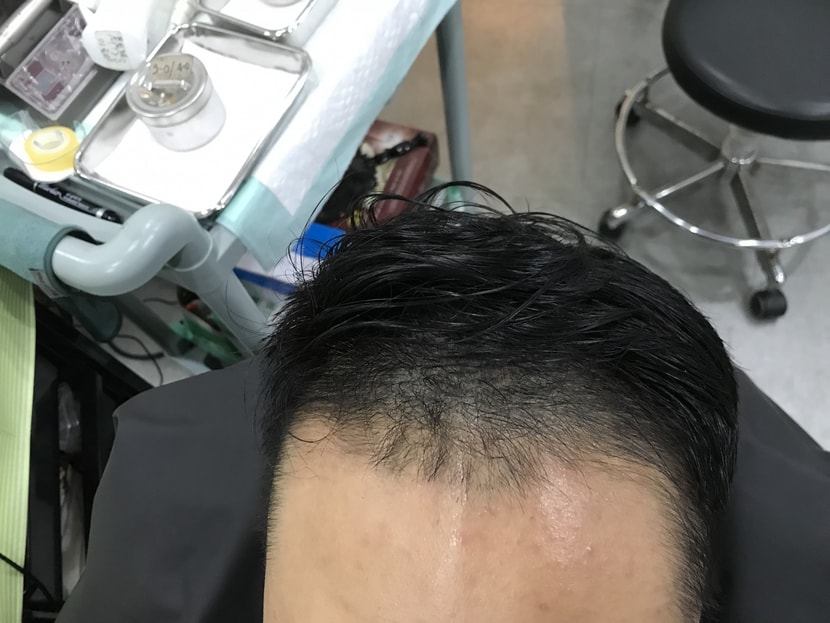 비포1