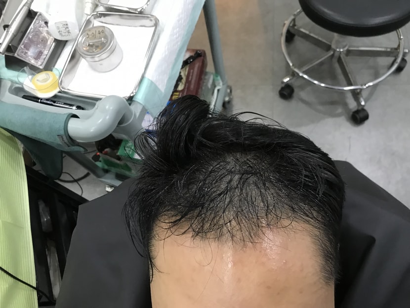 비포2