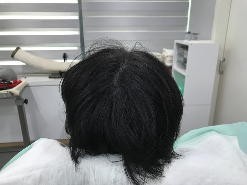 리터치 후, 정수리