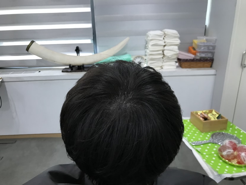 시술 후 1