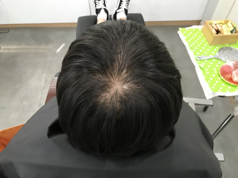 頭頂頭皮タトゥー1次体験談