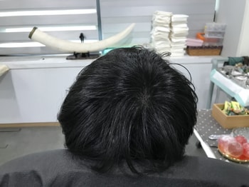 시술후 마른 상태