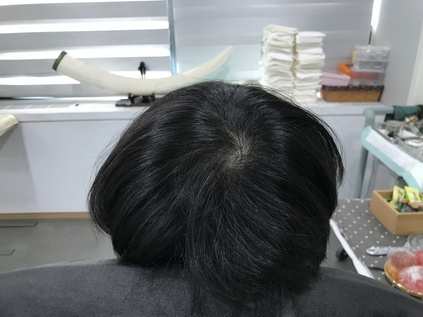 시술전 마른 상태